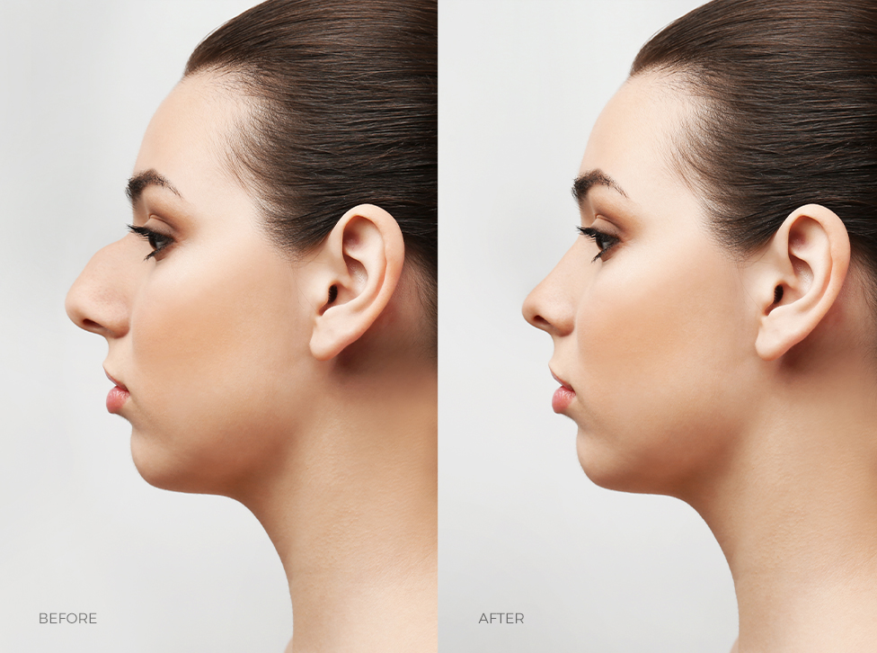 Rhinoplasty